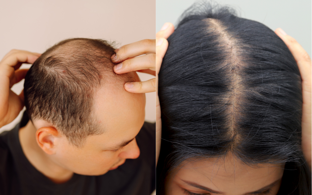 men vs women’s hair loss